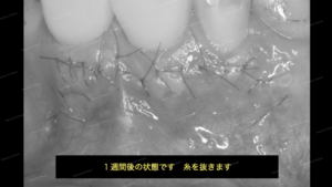 歯茎の白い出来物の腫れの治し方　外科治療・歯根端切除　７